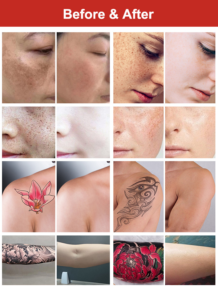 Non invasive Laser Skin Care18